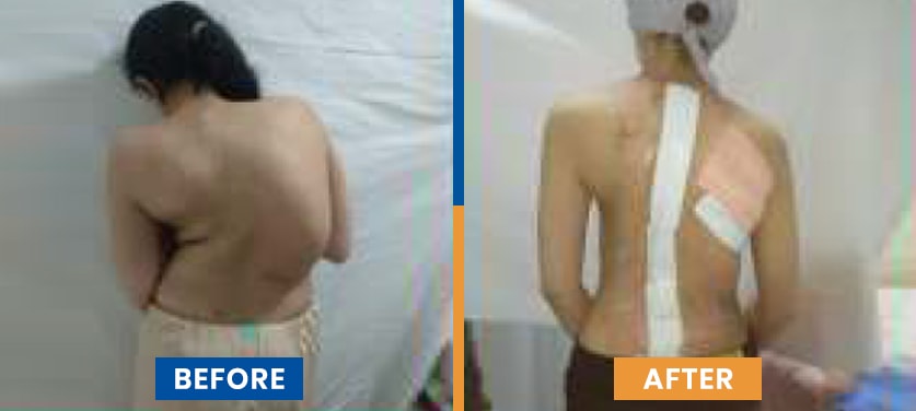 Scoliosis and Spine Surgery Before After Photos